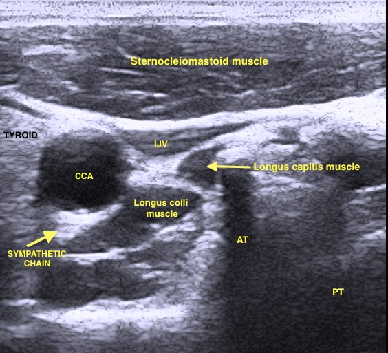 Sonographic visualisation of sympathetic chain at C6 vertebral level