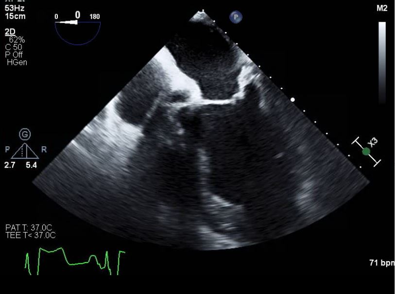 TEE Mid-esophageal 4-chamber view