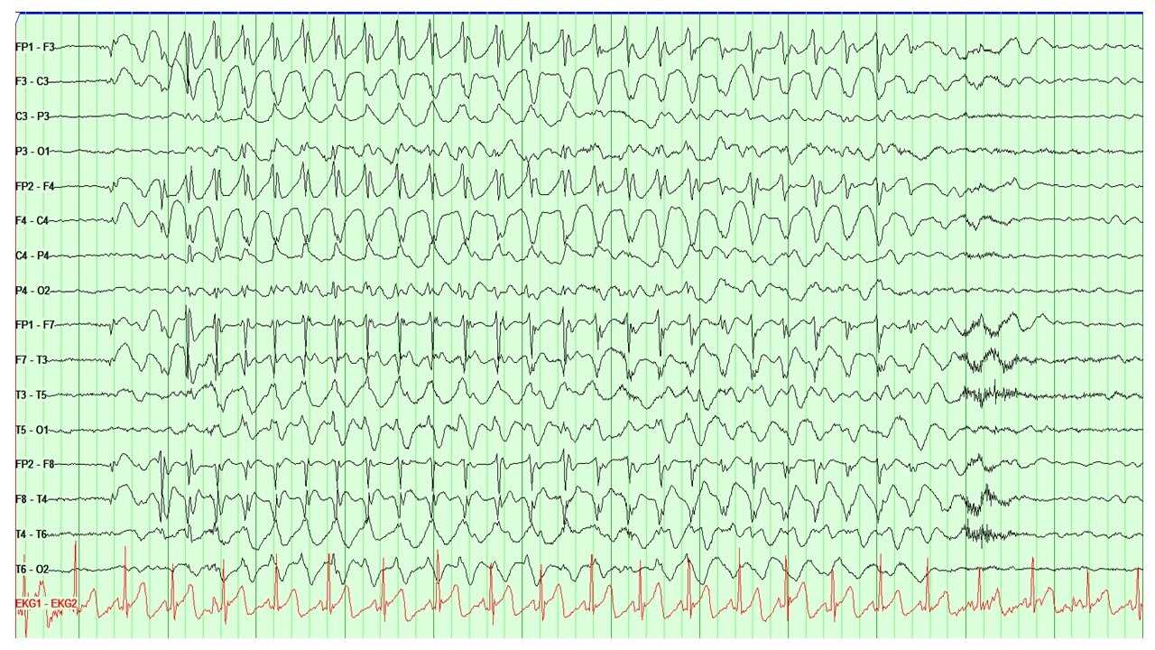 <p>Electroencephalogram (EEG), Absence Epilepsy