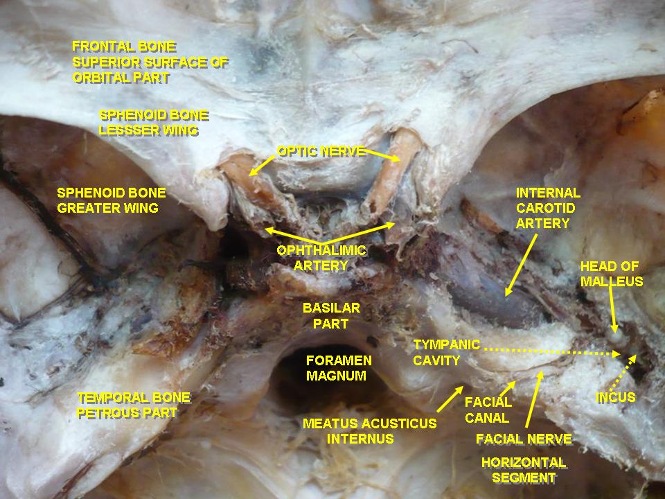 <p>Optic Nerves Arising From Optic Canals</p>