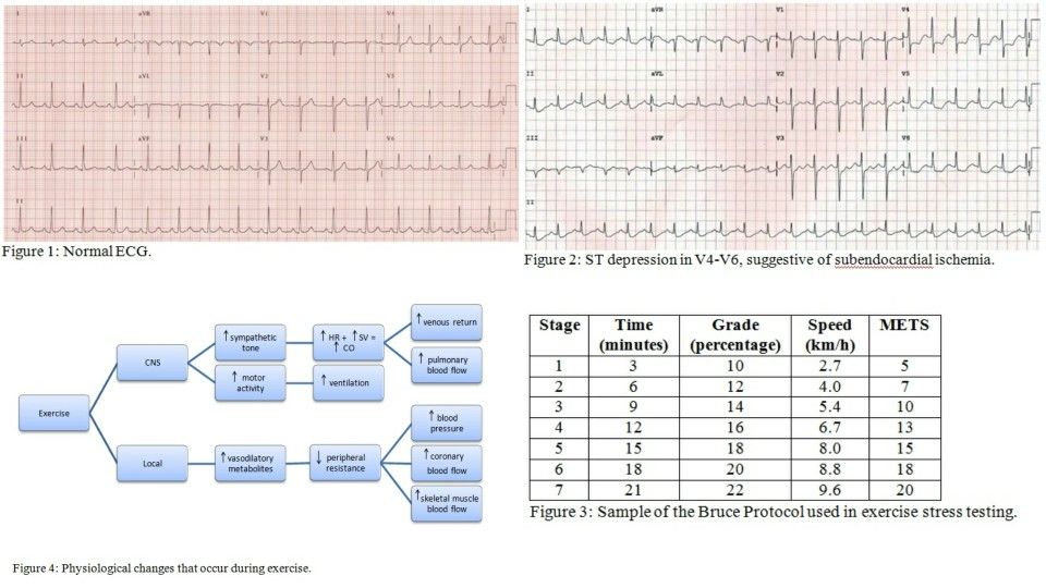 Stress testing ECG and Charts