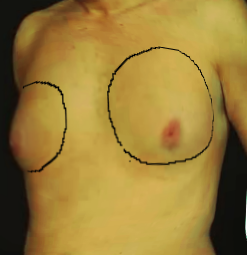 Gynecomastia