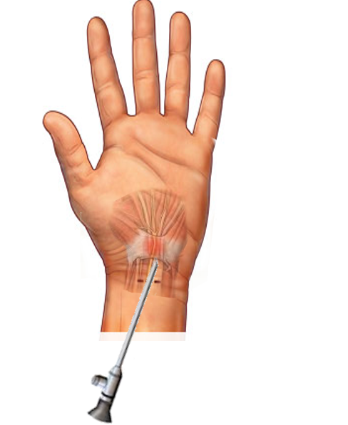 <p>Injection Treatment for Carpal Tunnel Syndrome