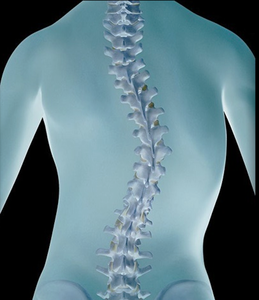 <p>Scoliosis of the Spine