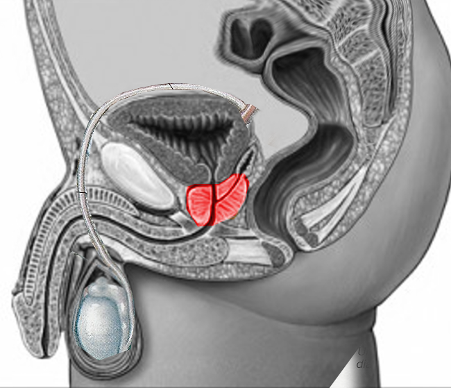 The Prostate gland