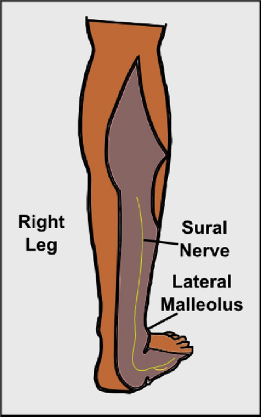 Sural Nerve Block Figures