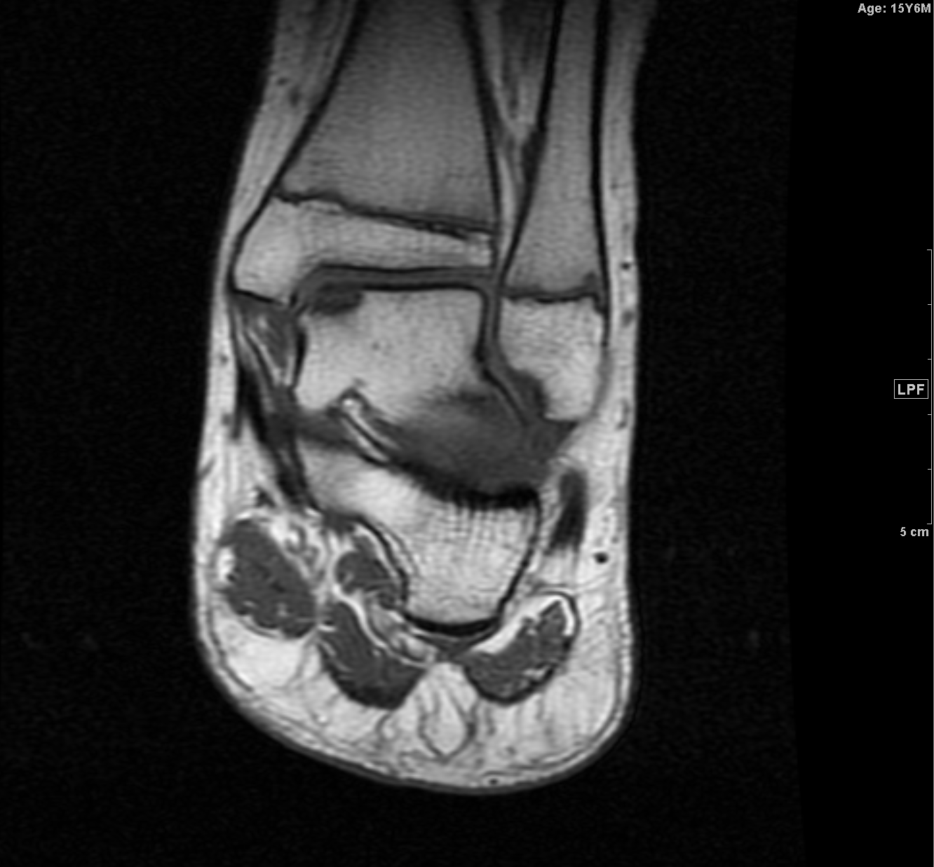 MRI T1 coronal - talus osteochondritis dissecans