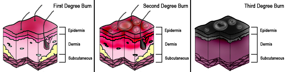 <p>Degrees of Burns.</p>