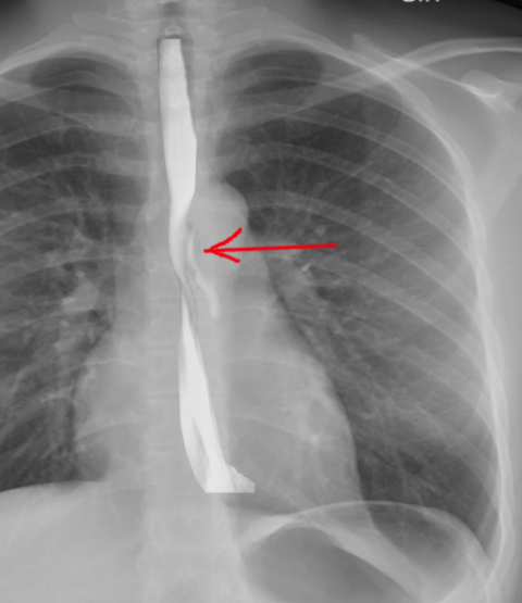 <p>Perforation of the Esophagus.</p>