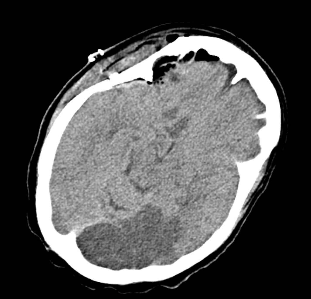 <p>Axial Section on Noncontrast CT Head Shows Left PCA Ischemic Stroke and No Hemorrhage.</p>