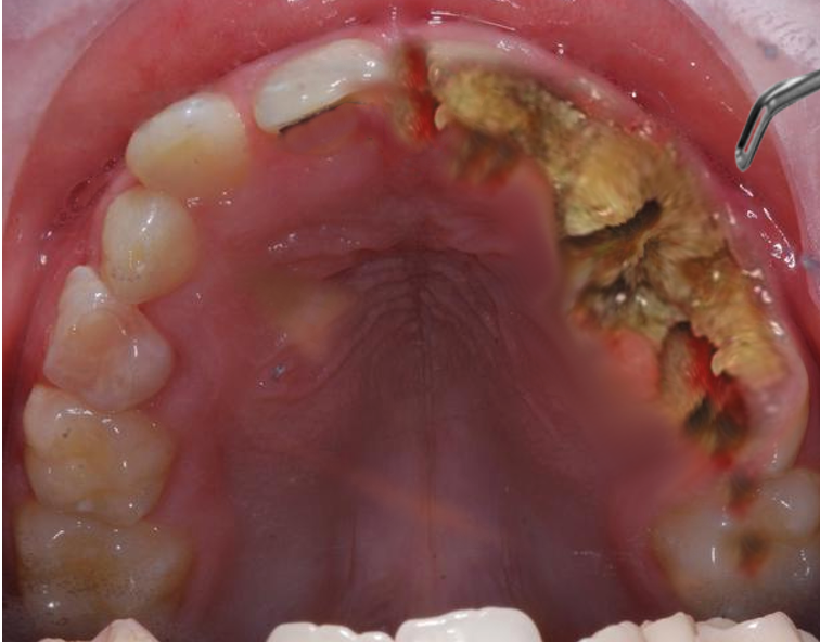 Jaw Osteonecrosis