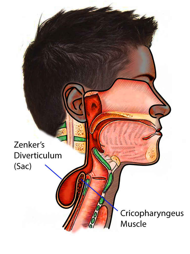 <p>Zenker Diverticulum</p>