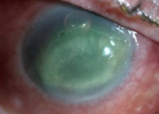 <p>Stage 2 Neurotrophic Keratitis