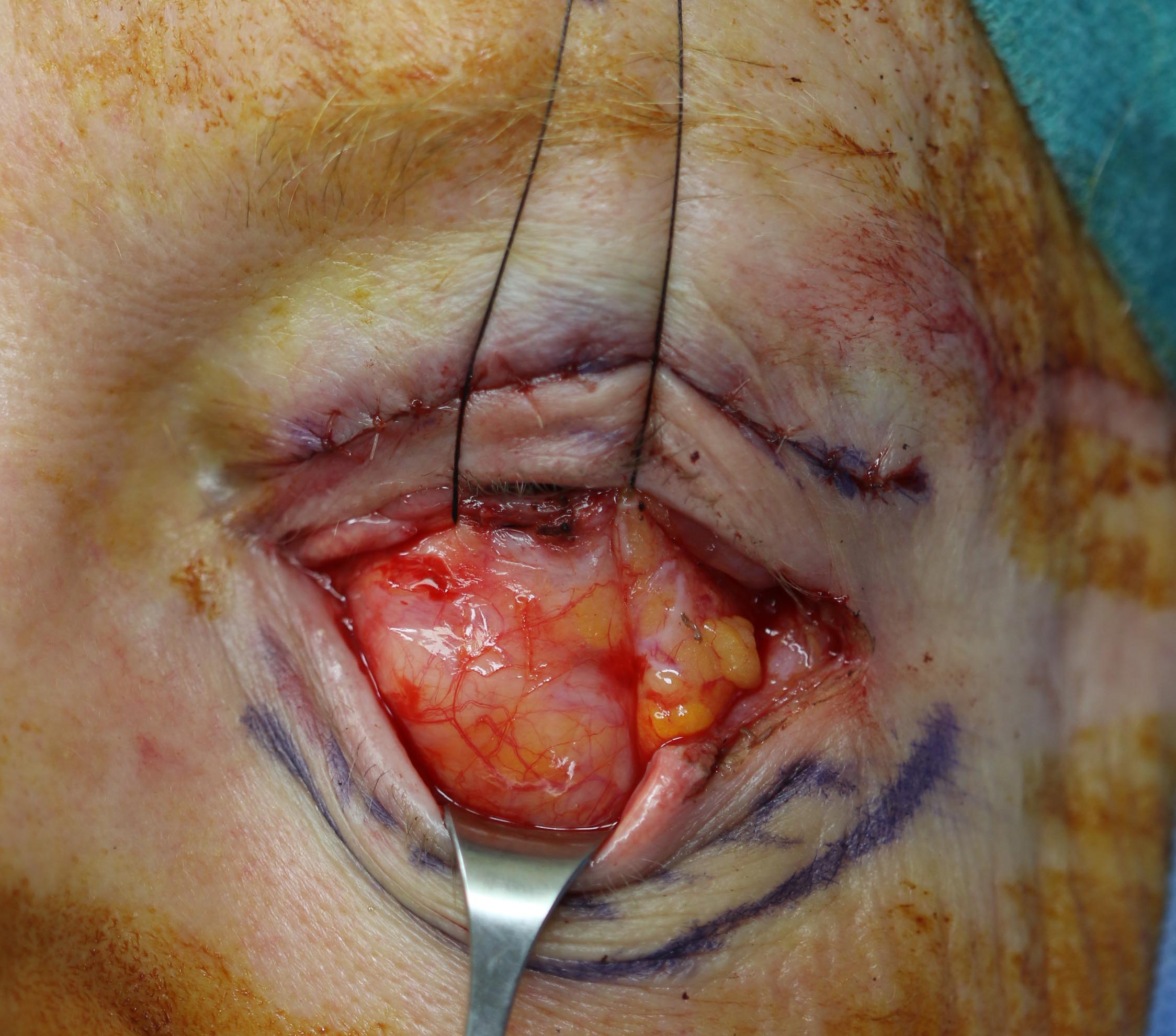 A transconjunctival blepharoplasty being performed with a lateral canthotomy and cantholysis illustrating the medial, the central and lateral fat pads