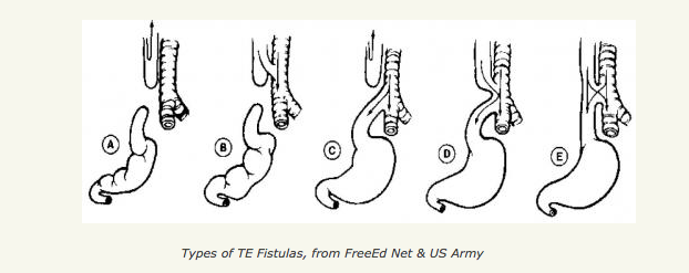 <p>Types of Tracheoesophageal Fistulas. This image shows the differences between tracheoesophageal fistula subtypes.</p>