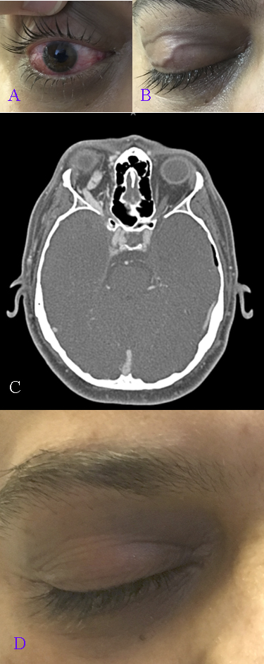 <p>Carotid Cavernous Fistula, Symptoms and Imaging