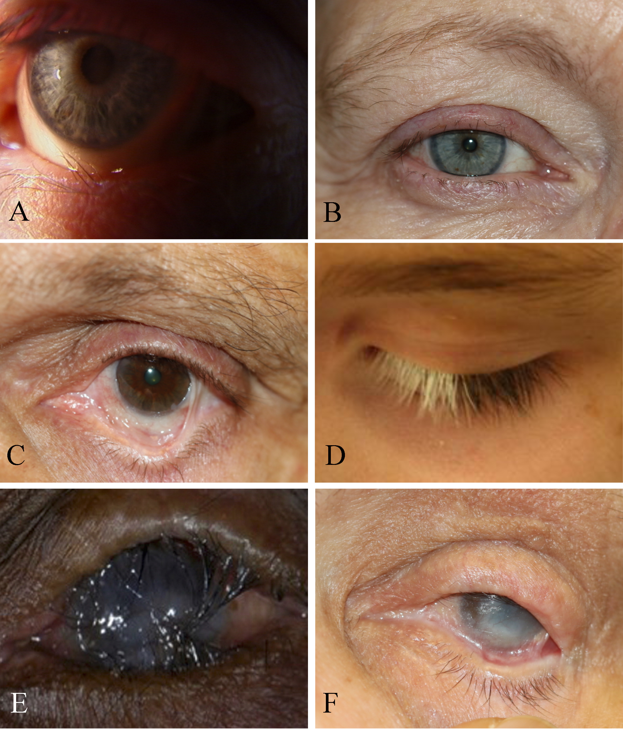 <p>Eye Disorders and Trachoma-Associated Symptoms, Trichiasis