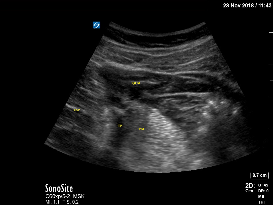 Lateral ultrasonographic view of Quadratus Lumborum Muscle