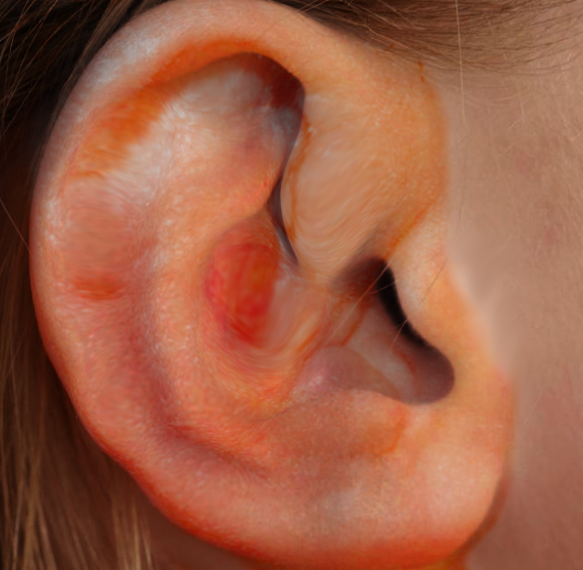 <p>Auricular Hematoma