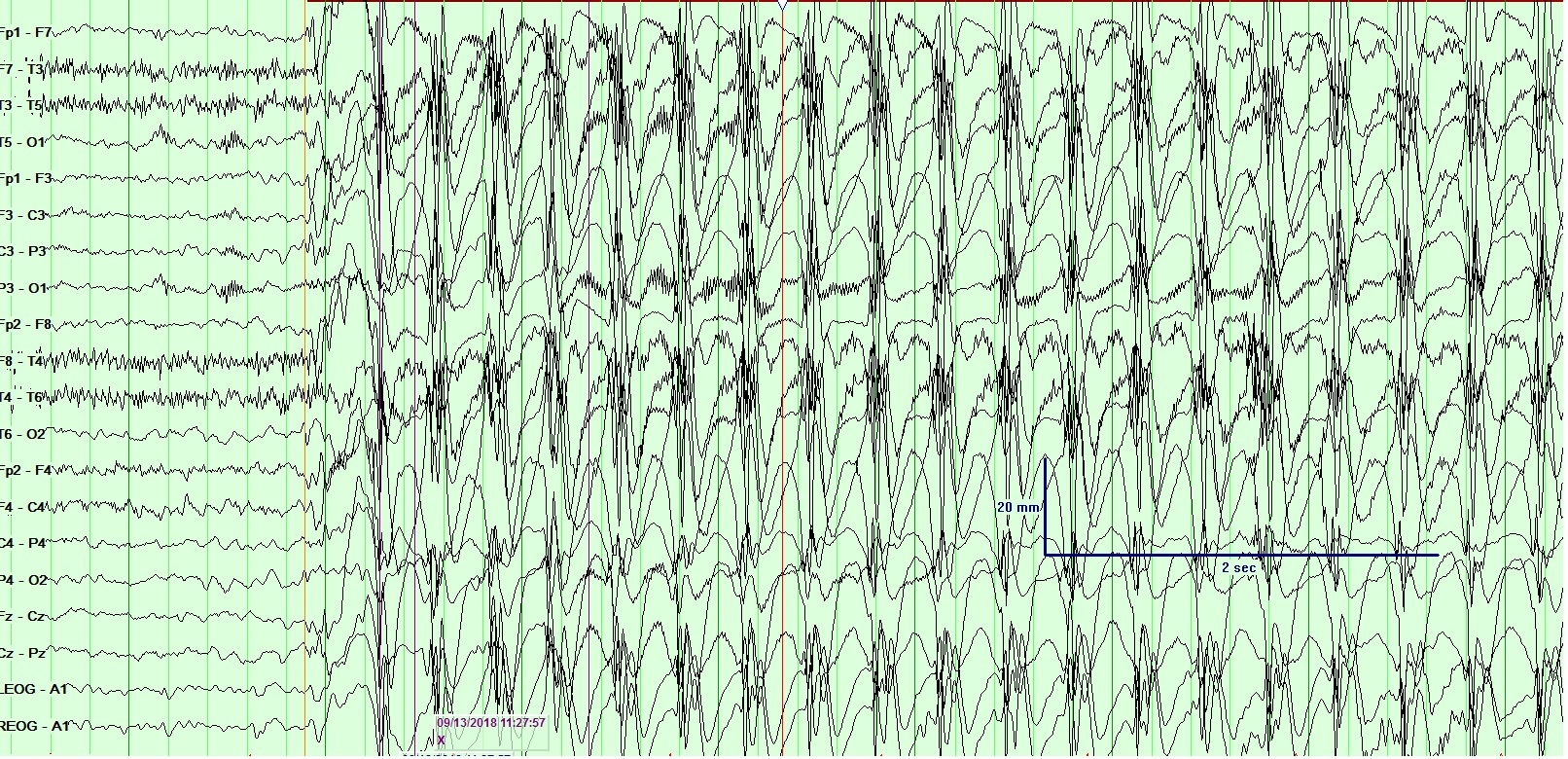 <p>Electroencephalogram (EEG), General Epileptiform. This EEG shows the characteristics of a general epileptic seizure.</p>