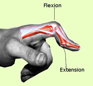 Boutonniere Deformity