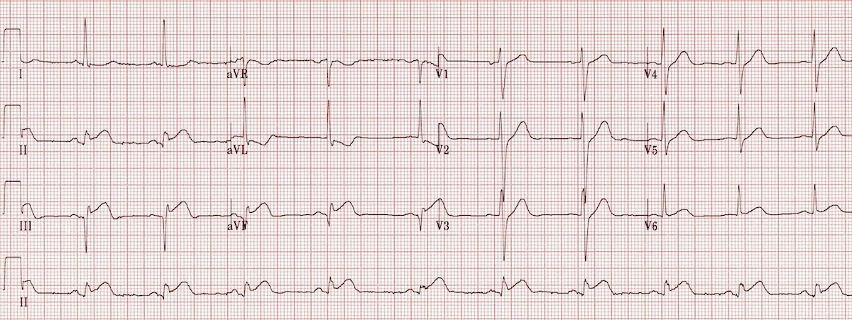 <p>Inferior Wall&nbsp;Myocardial Infarction. Note the elevated ST segments in leads II, III, and aVF.</p>