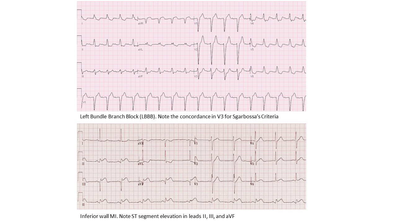 <p>Left Bundle Branch Block on Electrocardiography