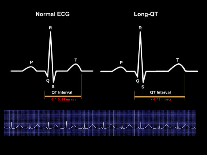 Prolonged QT Interval