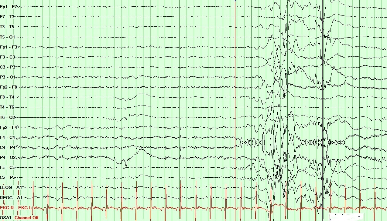 Neonatal EEG showing Burst Suppression pattern in Ohtahara syndrome