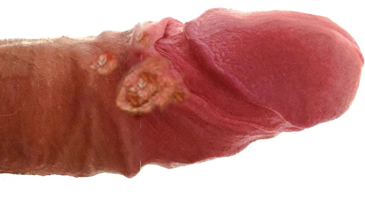 <p>Lymphogranuloma Venereum