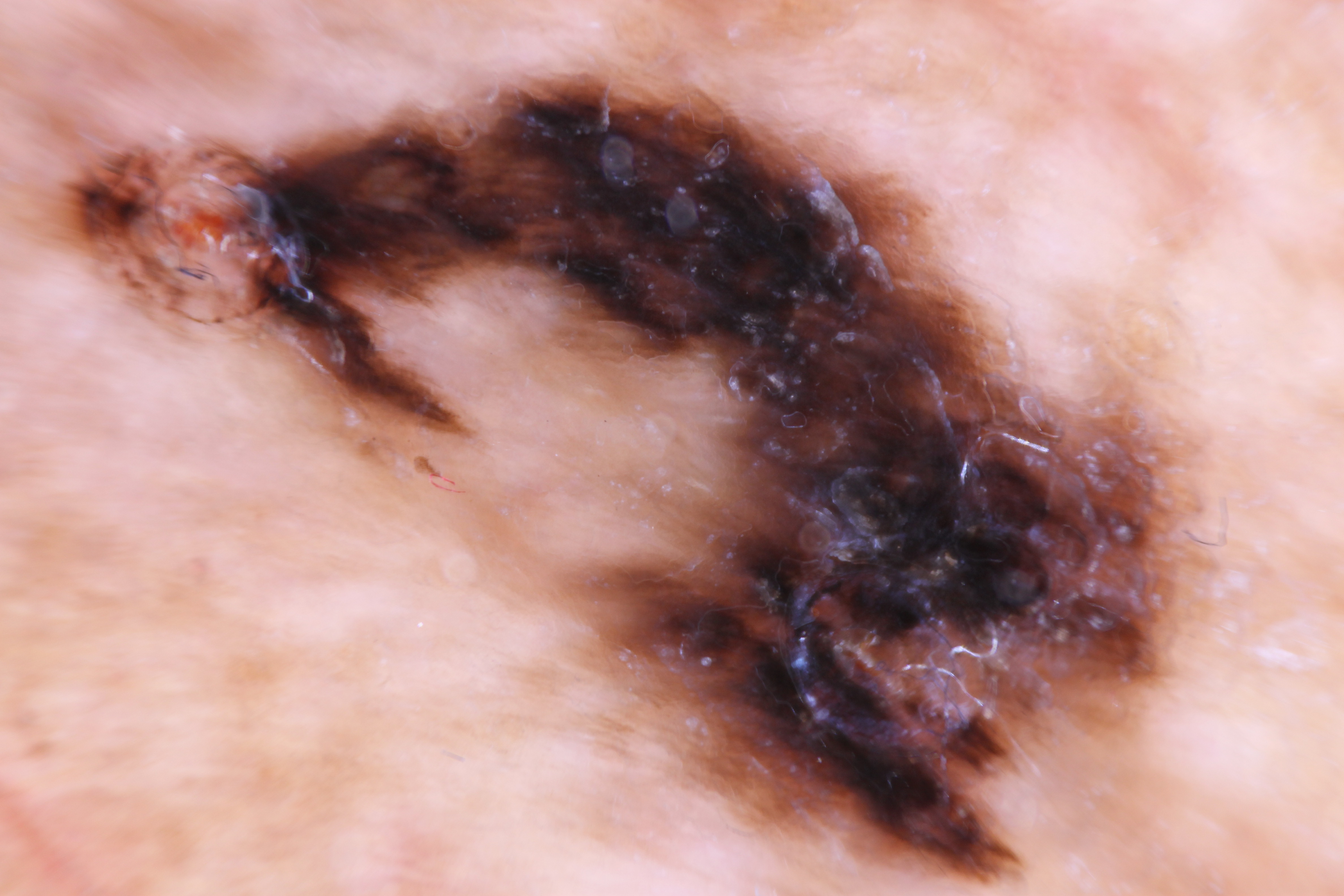 <p>Acral Lentiginous Melanoma