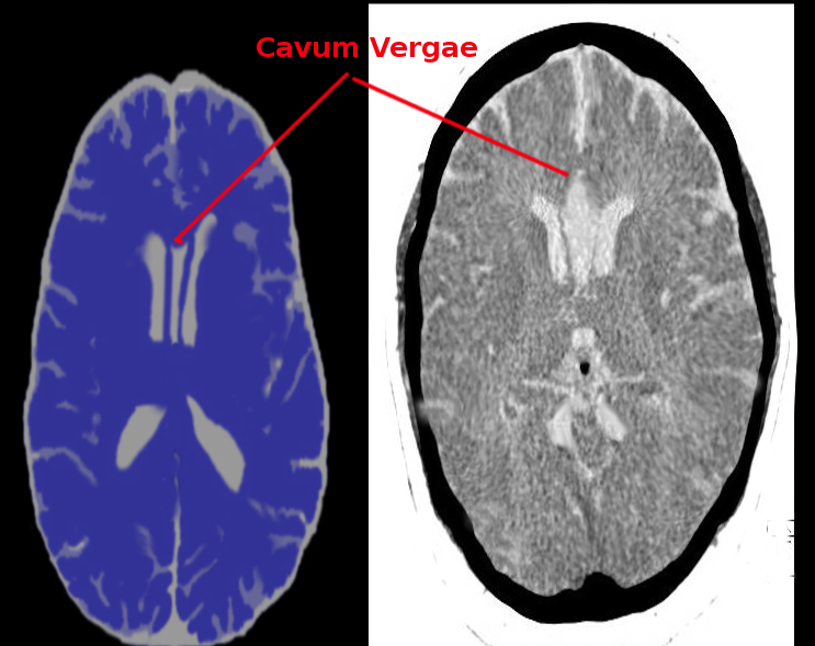 cavum septum pellucidum