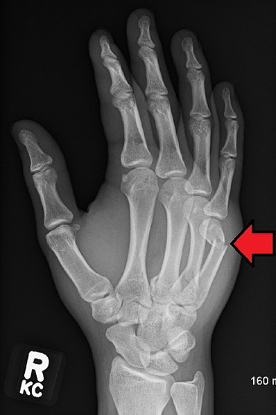 Fractured 5th metacarpal