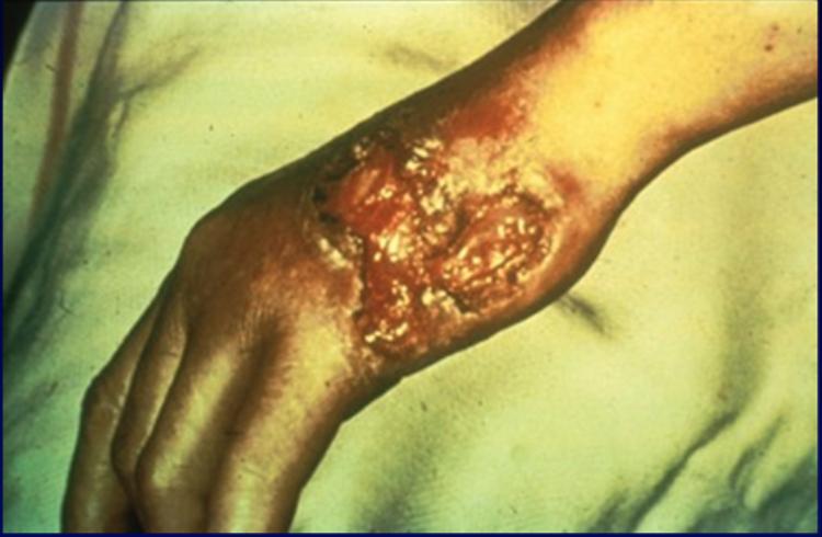 <p>Syphilis Gummas Lesion</p>