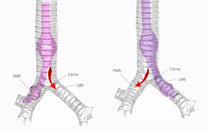 Single lung ventilation