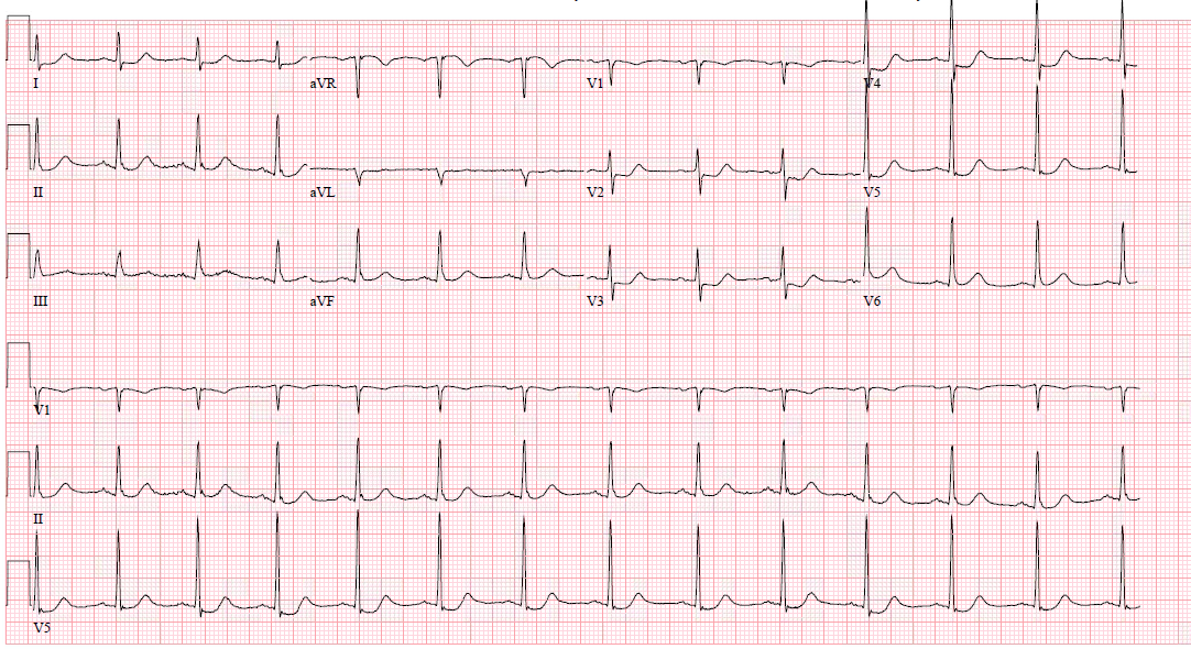 Isolated posterior MI (OMI), cath proven 100% proximal circumflex with TIMI 0 flow (example 2)