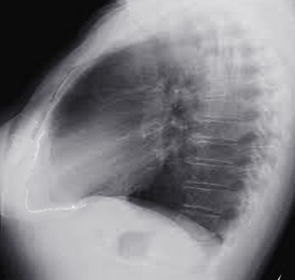 S/P CABG pericardial calcification