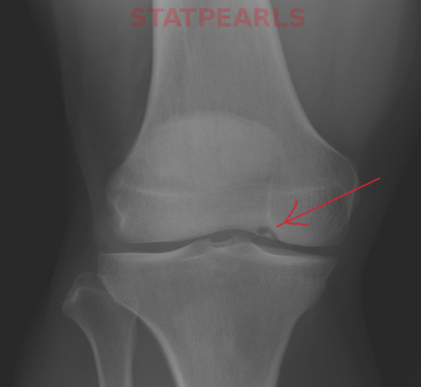 Osteochondritis dessicans