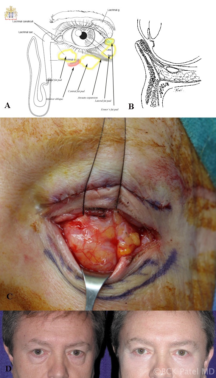 <p>Transconjunctival Lower Blepharoplasty in a Male