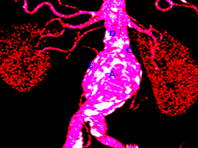 <p>Abdominal Aortic Aneurysm Rupture</p>