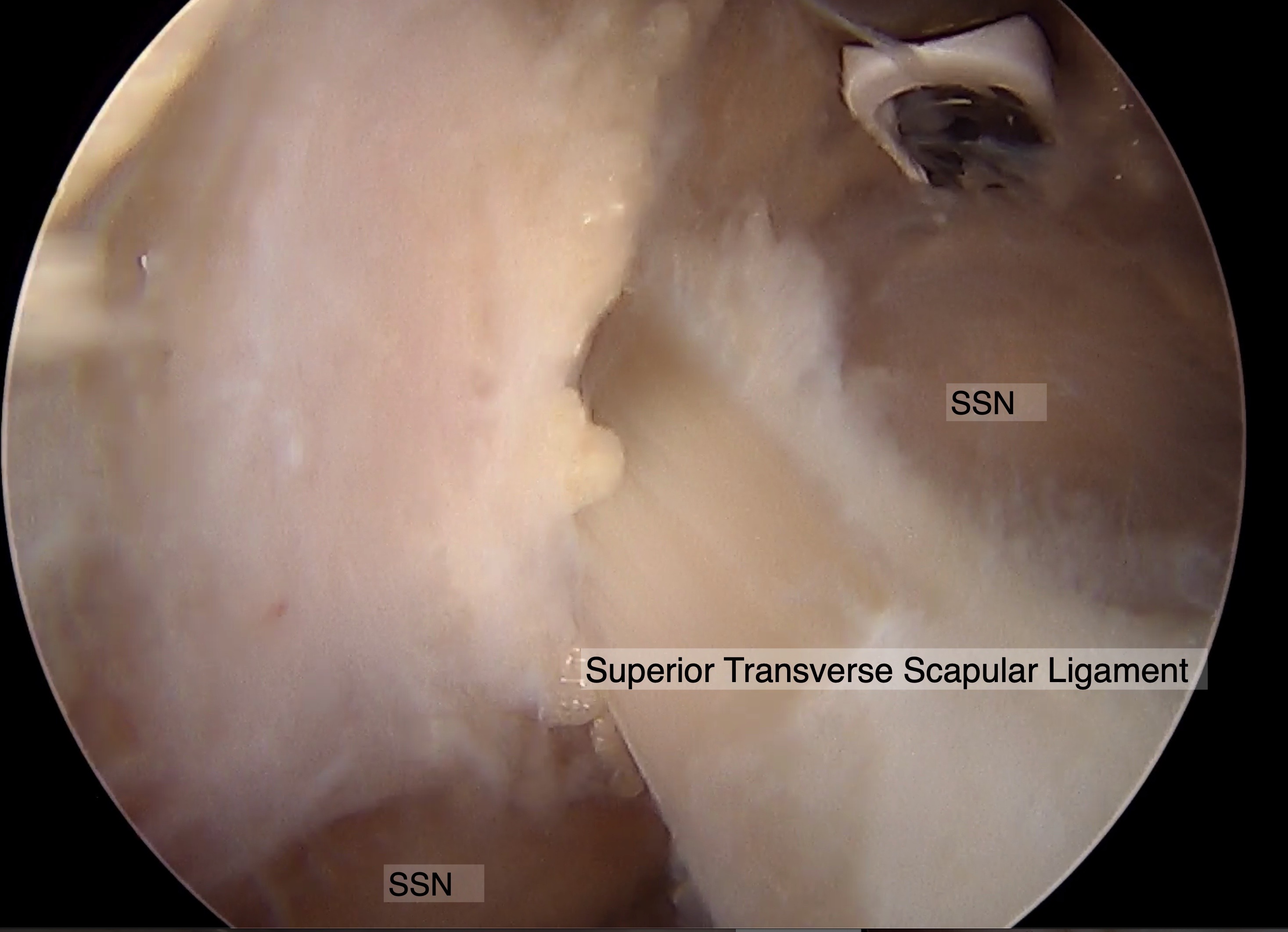 <p>Suprascapular Nerve Course, Arthroscopic Image