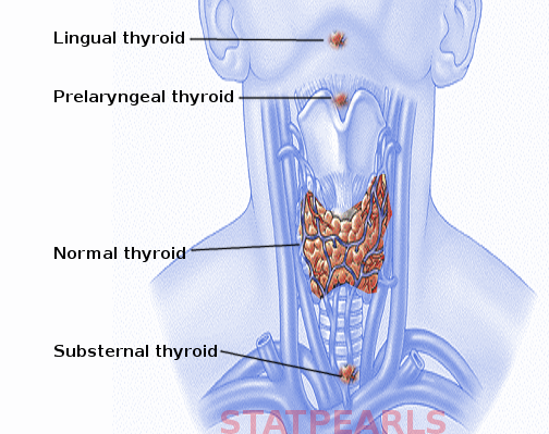 <p>Ectopic Thyroid