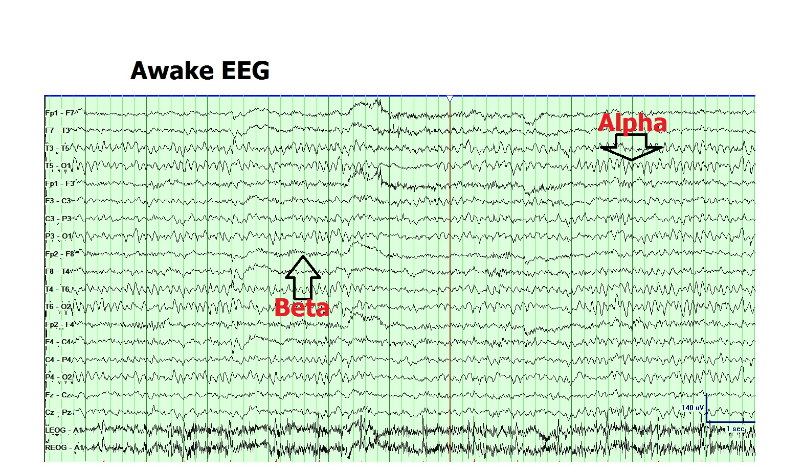 <p>Normal Awake Electroencephalogram