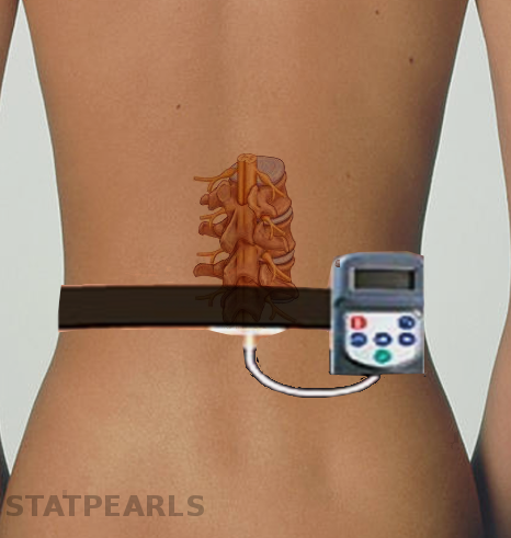 <p>Peripheral Nerve Stimulator</p>