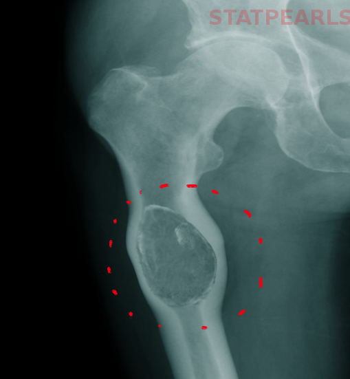 <p>Bone Cyst in Proximal Femur</p>