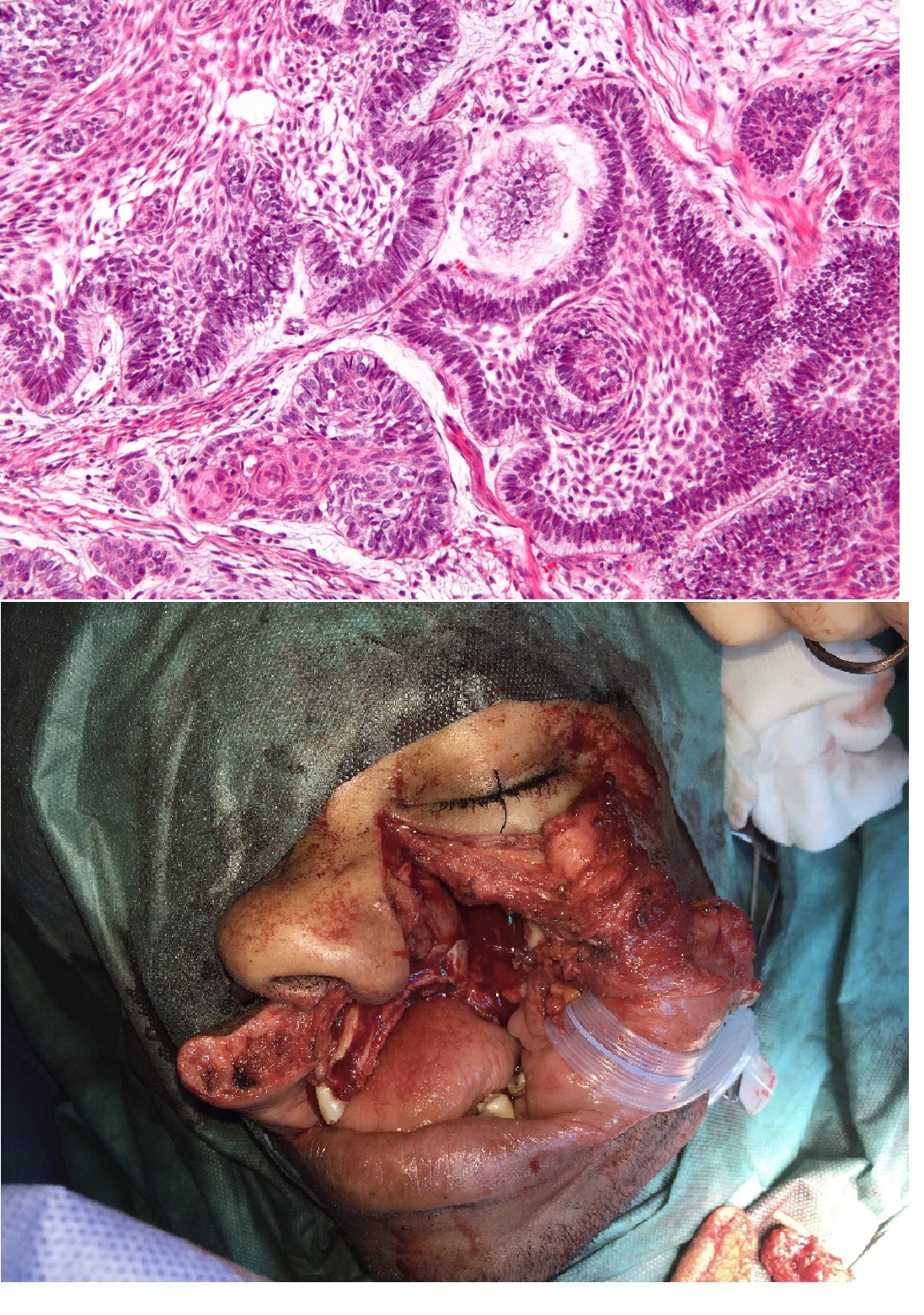 (Top) High magnification micrograph of an ameloblastoma