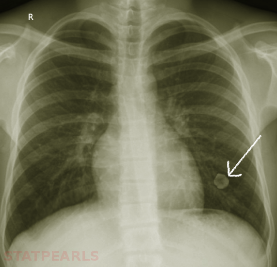 <p>&nbsp;Lung Hamartoma