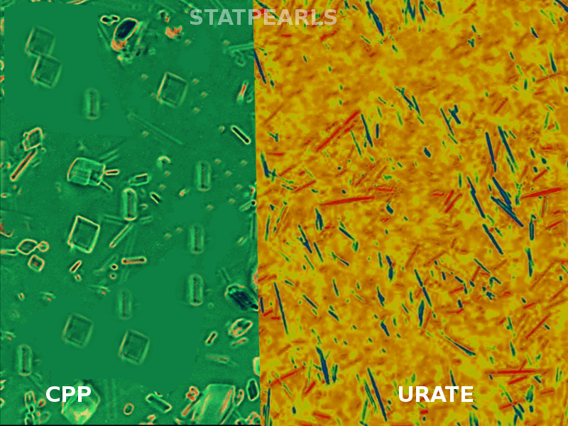 <p>CPP and Urate Crystals</p>