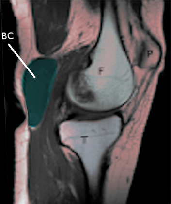 Baker's cyst MRI