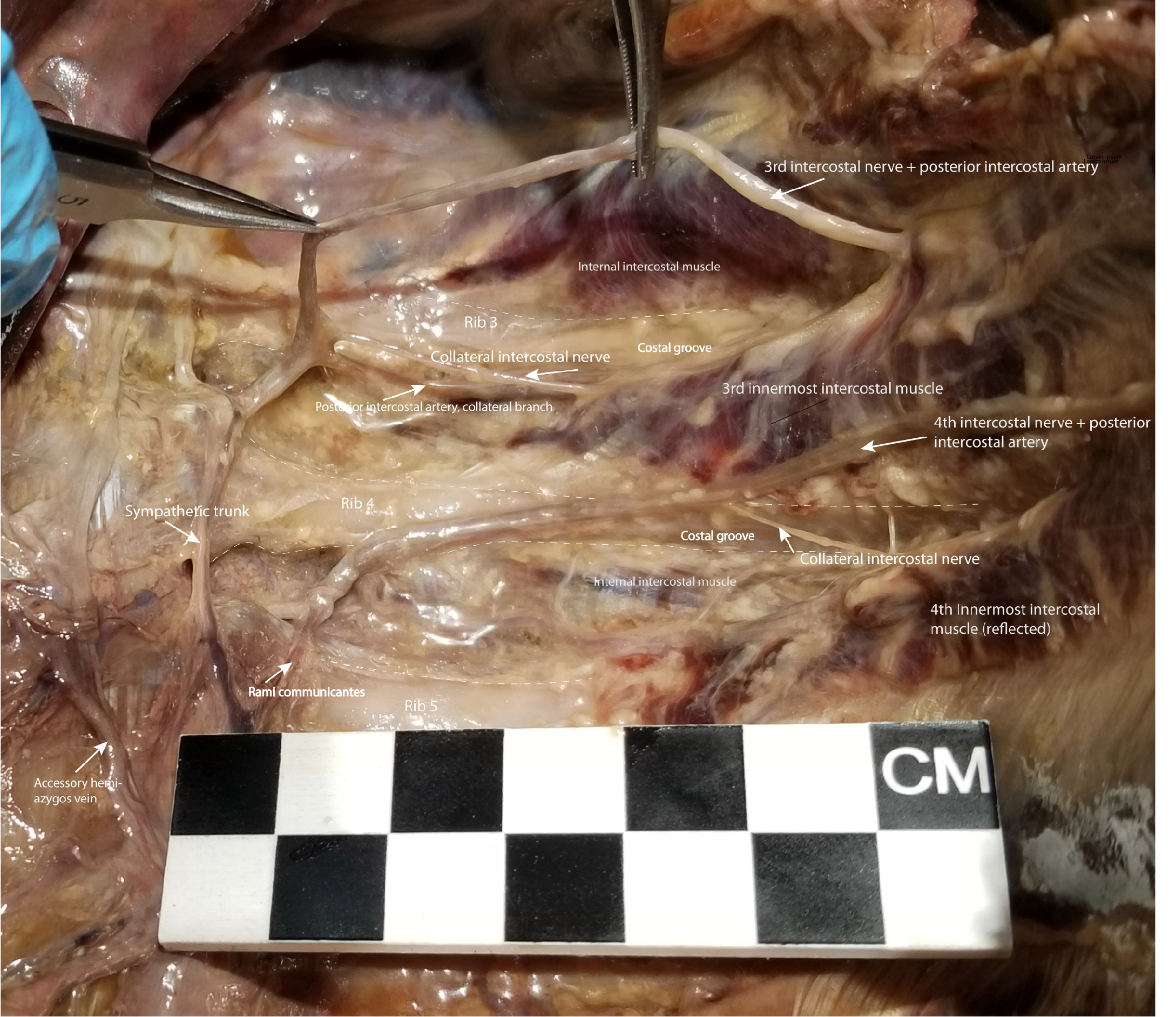 <p>Dissection of the Left Posterior Thoracic Wall Showing Intercostal Spaces 3 and 4